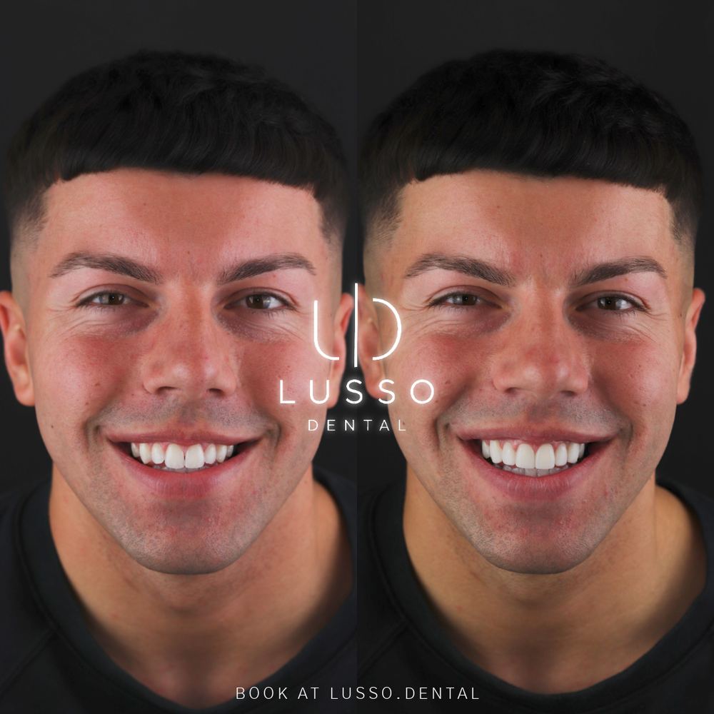 Smile makeover reaction