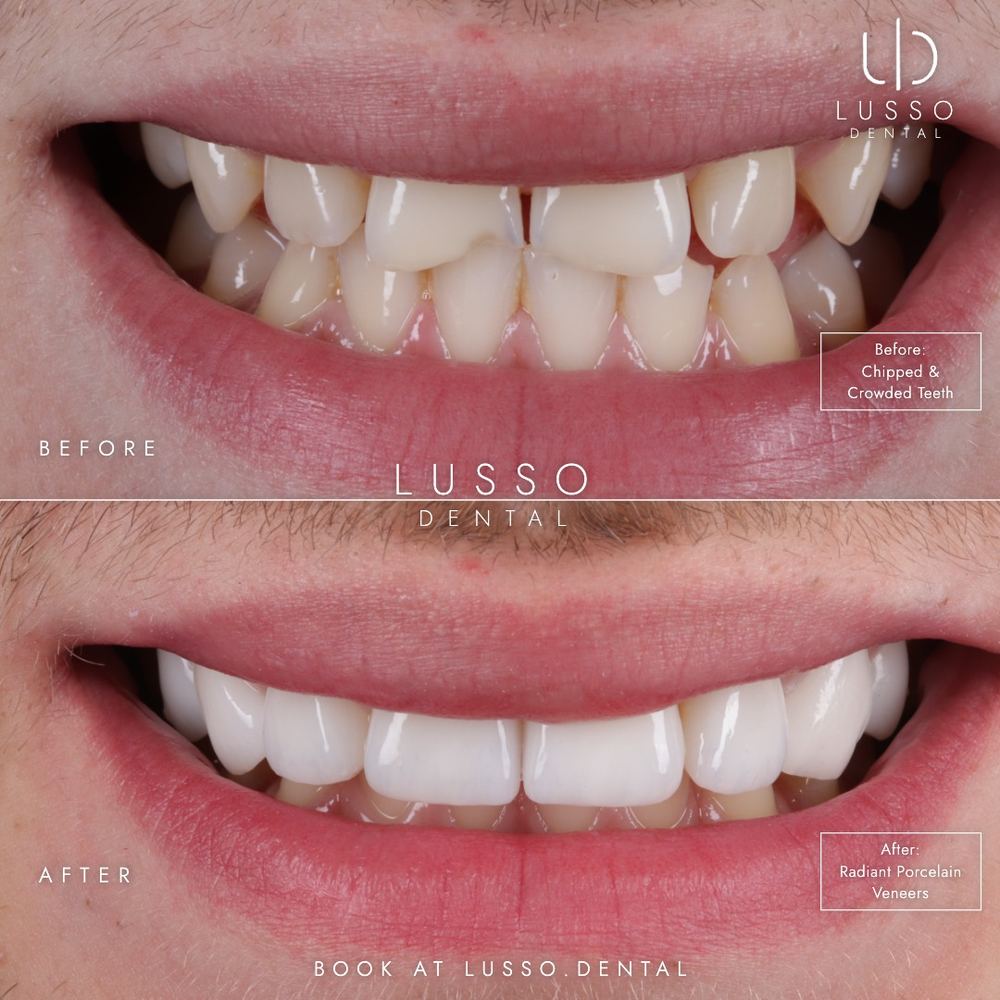 Porcelain veneers