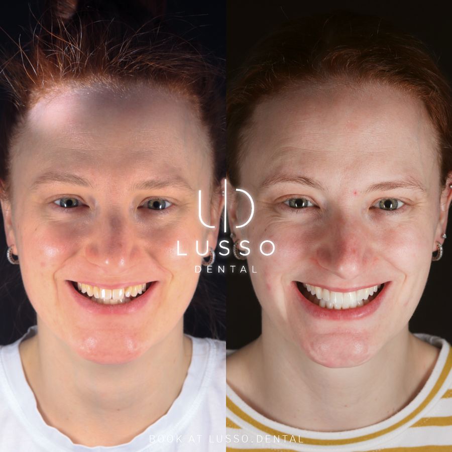 Before and after full face view: uneven, discoloured teeth transformed with a smile makeover