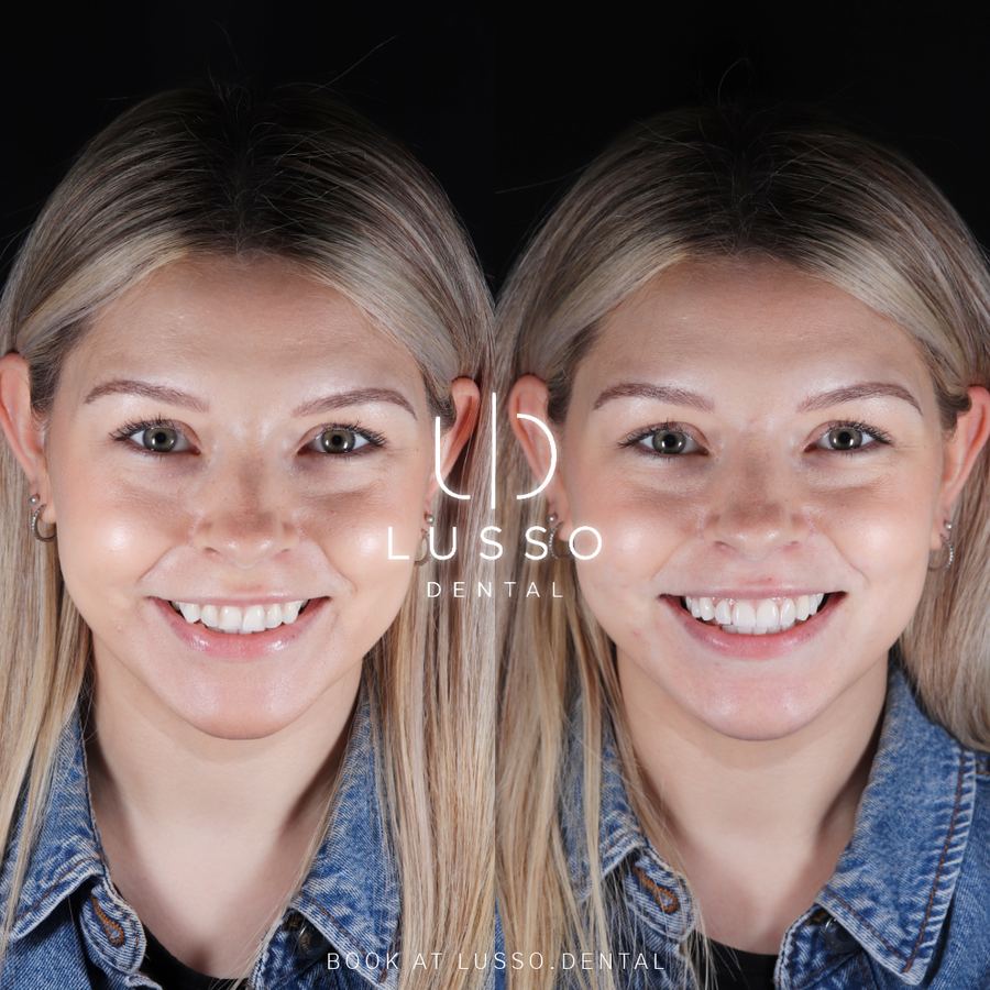 Before and after full face view: a brighter, more even smile after composite bonding
