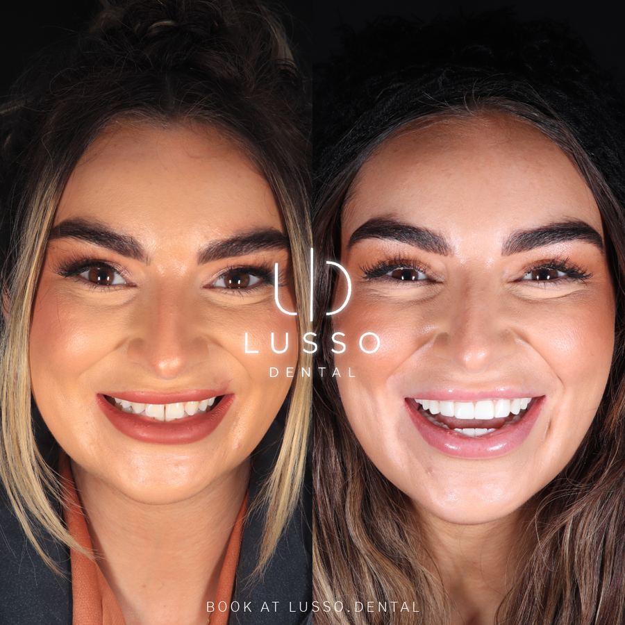 Before and after full face view: porcelain veneer smile makeover