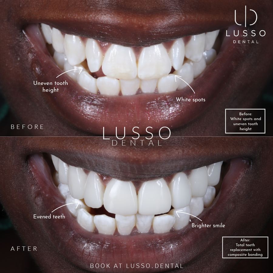 Before and after: white spots and uneven tooth height replaced with composite bonding