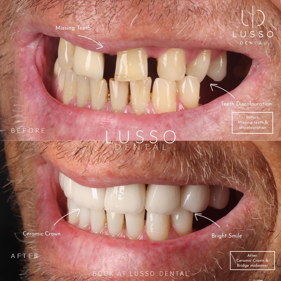 Before and after: missing teeth and discolouration restored with a ceramic crown and bridge makeover