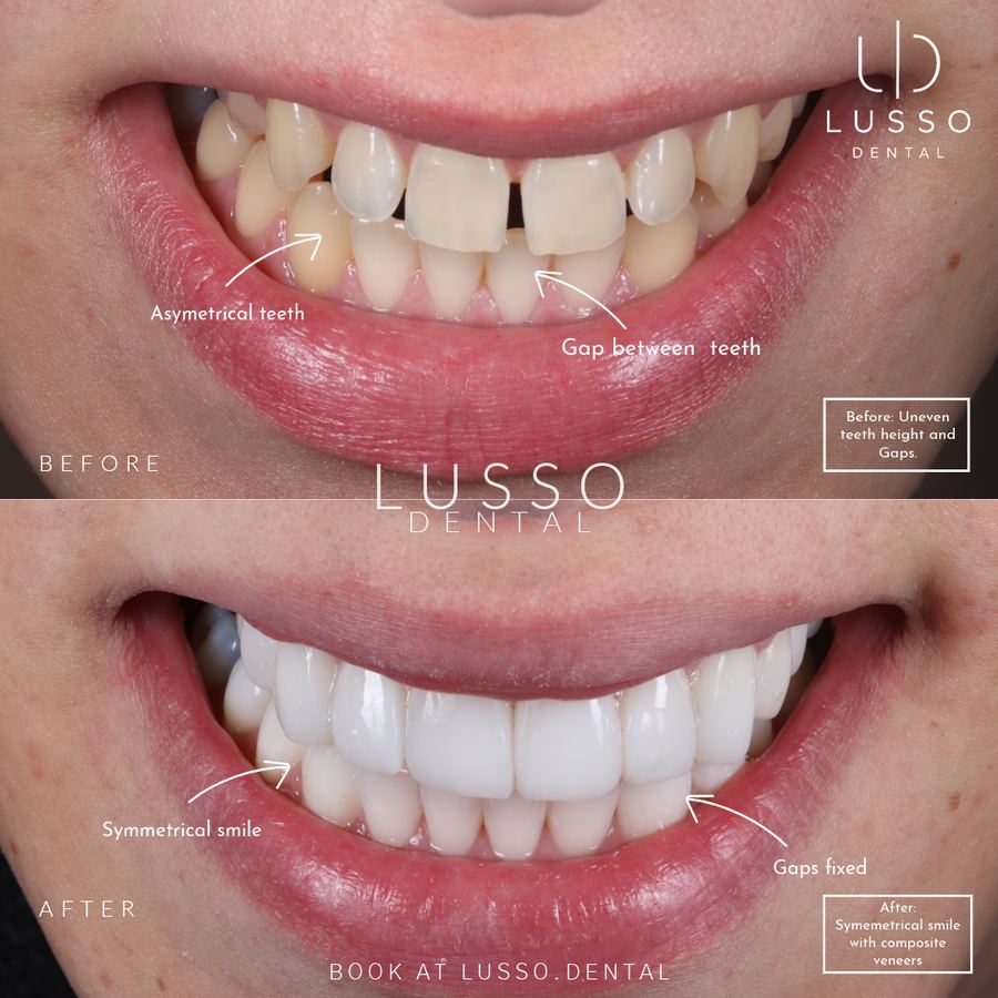 Before and after: asymmetrical teeth and gaps closed with composite veneers