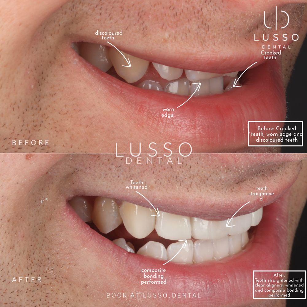 Clear aligners