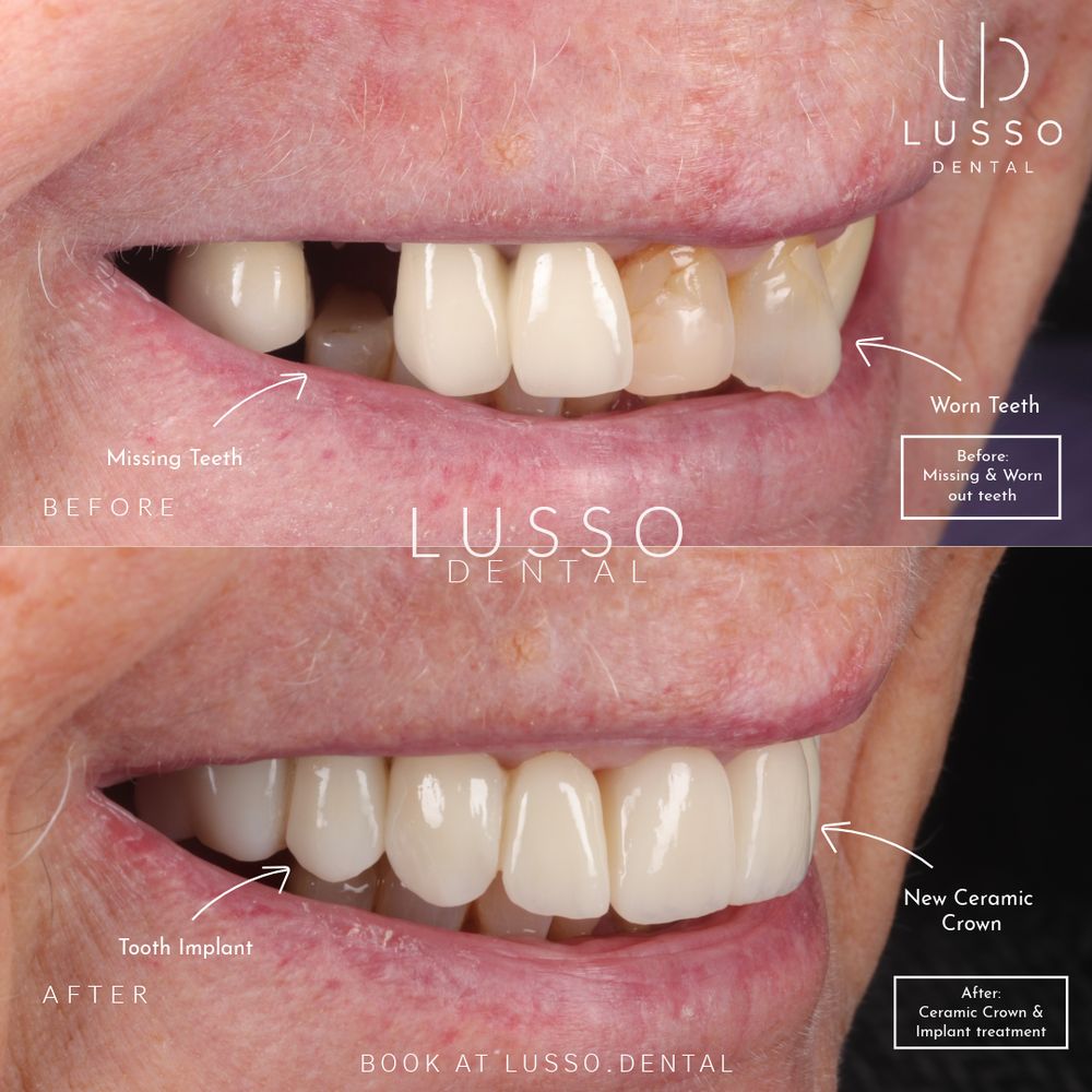 Dental implants