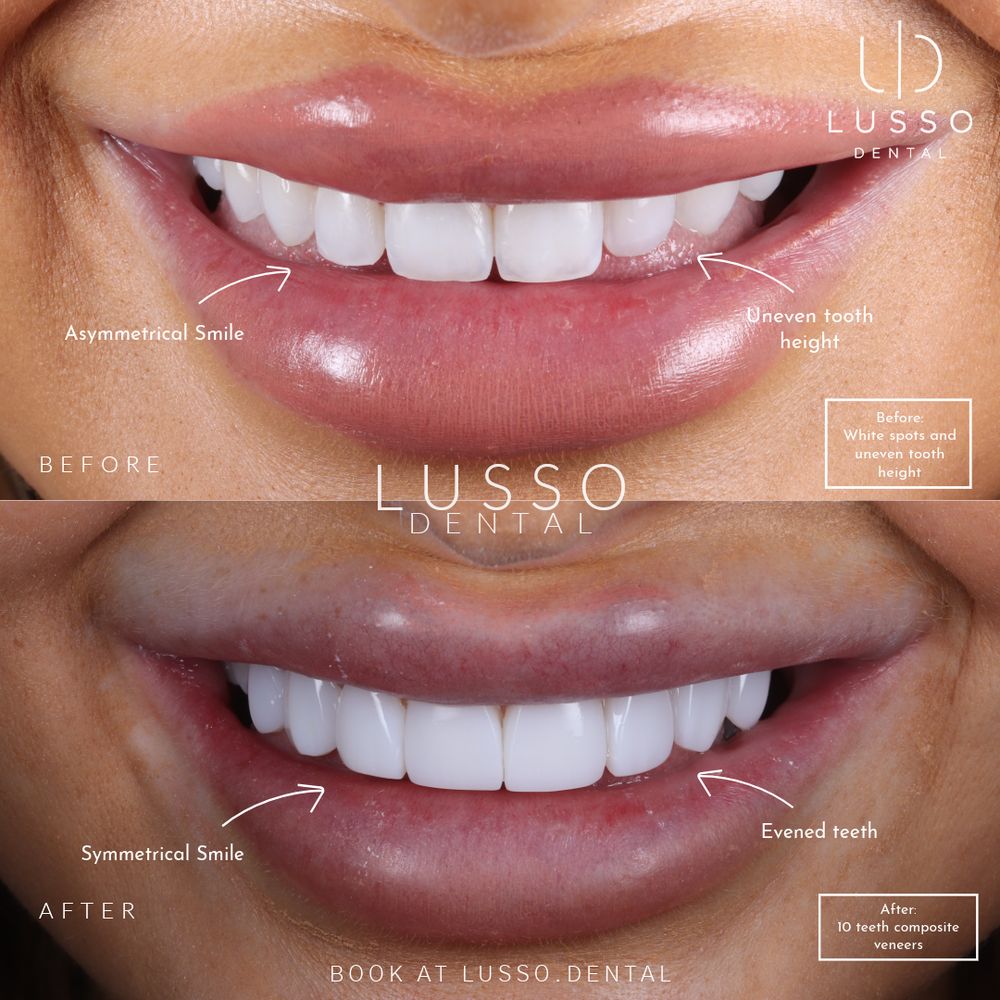 Smile makeover